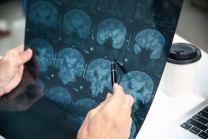 5 Questions to Ask Your Traumatic Brain Injury Lawyer